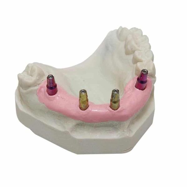 Dreve GumQuick Implant Set Gingiva Mask