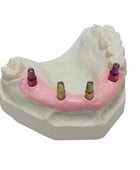 Dreve GumQuick Implant Set Gingiva Mask